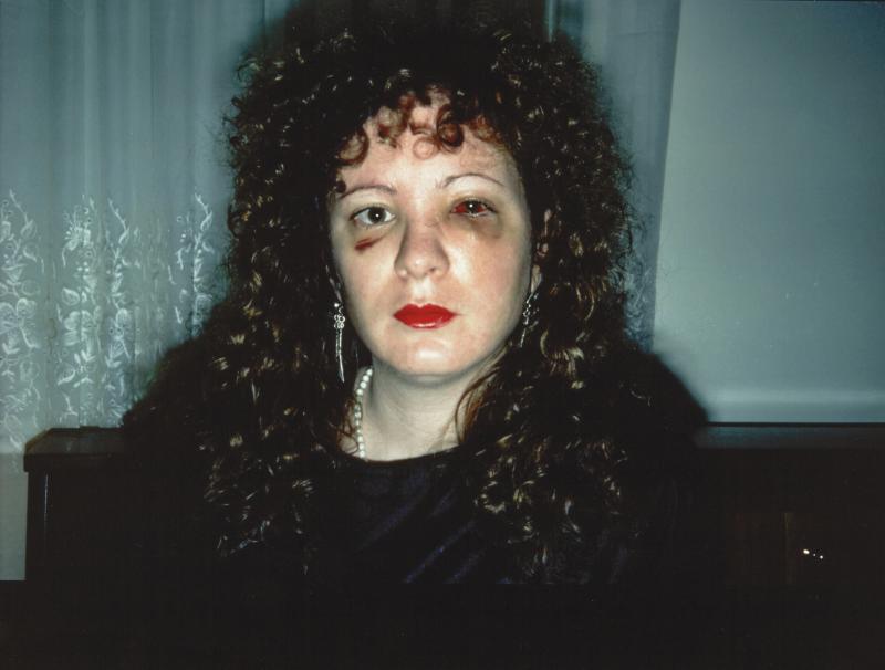 NAN GOLDIN (* 1953) ›Nan one month after being battered‹, 1984 Cibachrome c. 40 × 59 cm Rückseitig signiert Startpreis: € 3.600 / Schätzpreis: € 6.000-8.000 ￼￼￼￼