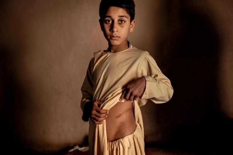 WORLD PRESS PHOTO STORY DES JAHRES Der Preis des Friedens in Afghanistan (The Price of Peace in Afghanistan) © Mads Nissen, Politiken/Panos Pictures, Da sie sich das Essen für die Familie nicht mehr leisten konnten, beschlossen die Eltern von Khalil Ahmad (15), seine Niere für 3 500 US-Dollar zu verkaufen. Der Mangel an Arbeitsplätzen und der grassierende Hunger haben zu einem dramatischen Anstieg des illegalen Organhandels geführt. Herat, Afghanistan, 19. Januar 2022.